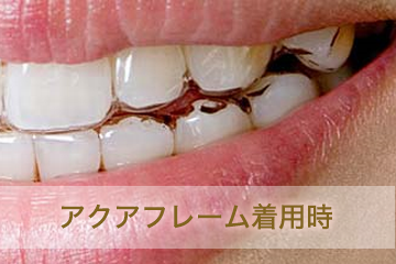 1.金属を使った目立つ矯正治療をしたくない!